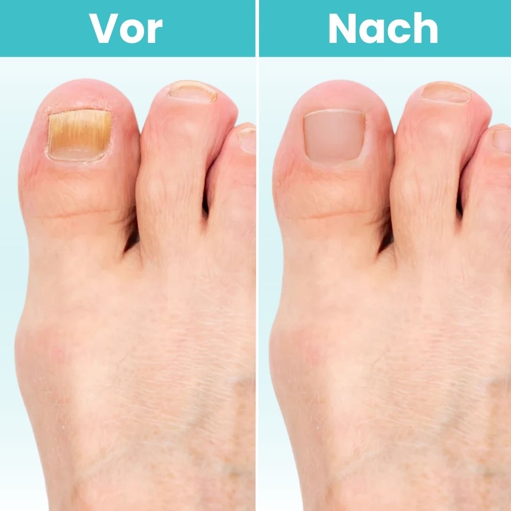 FungiClear Pro™ | Klare, Gesund Aussehende Nägel Zu Hause Wiederherstellen