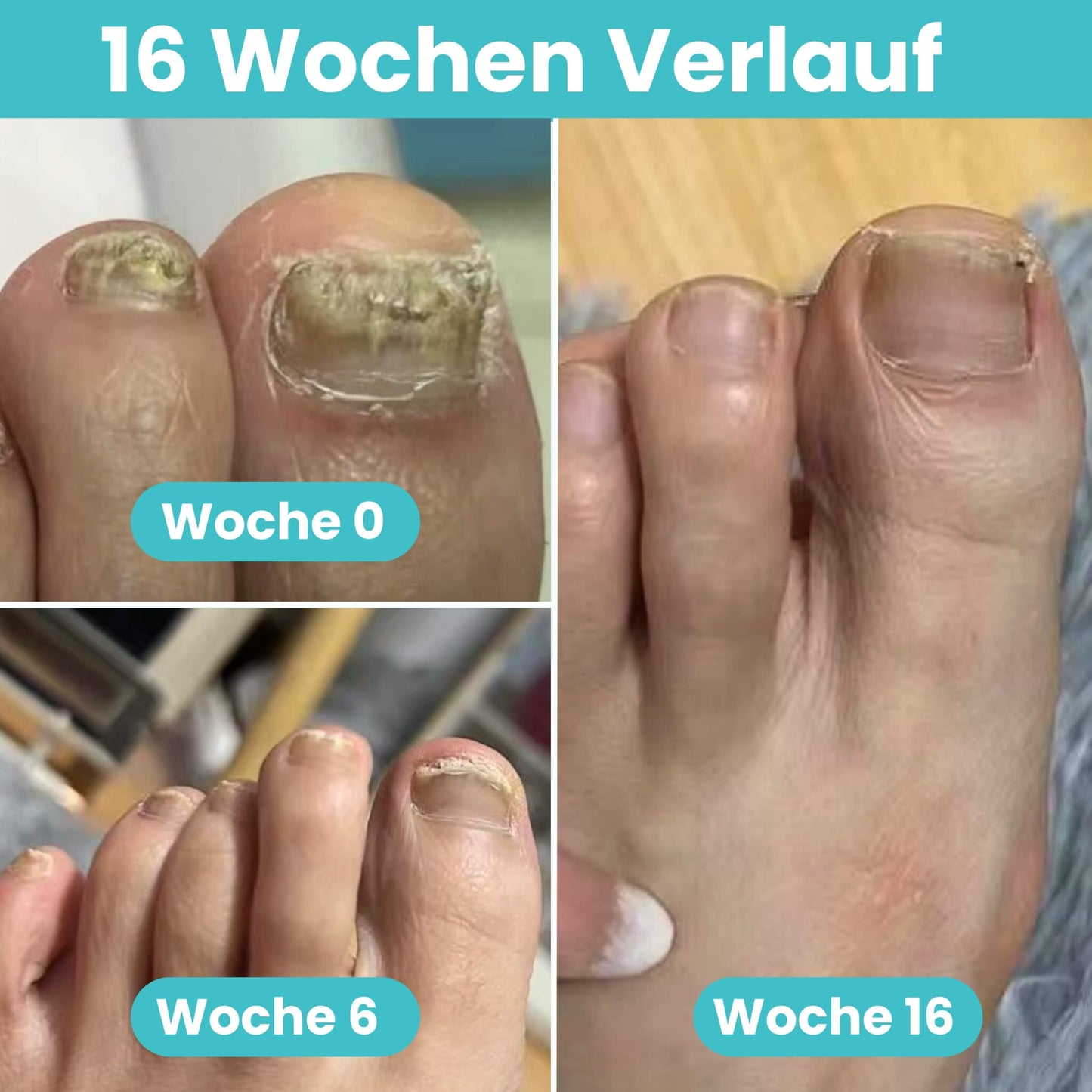 FungiClear Pro V2™ - Professionelle Heimbehandlung