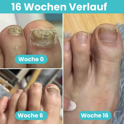 FungiClear Pro V2™ - Professionelle Heimbehandlung