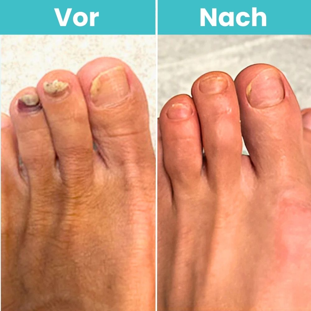 FungiClear Pro™ | Klare, Gesund Aussehende Nägel Zu Hause Wiederherstellen