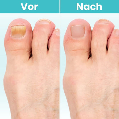 FungiClear Pro™ | Klare, Gesund Aussehende Nägel Zu Hause Wiederherstellen