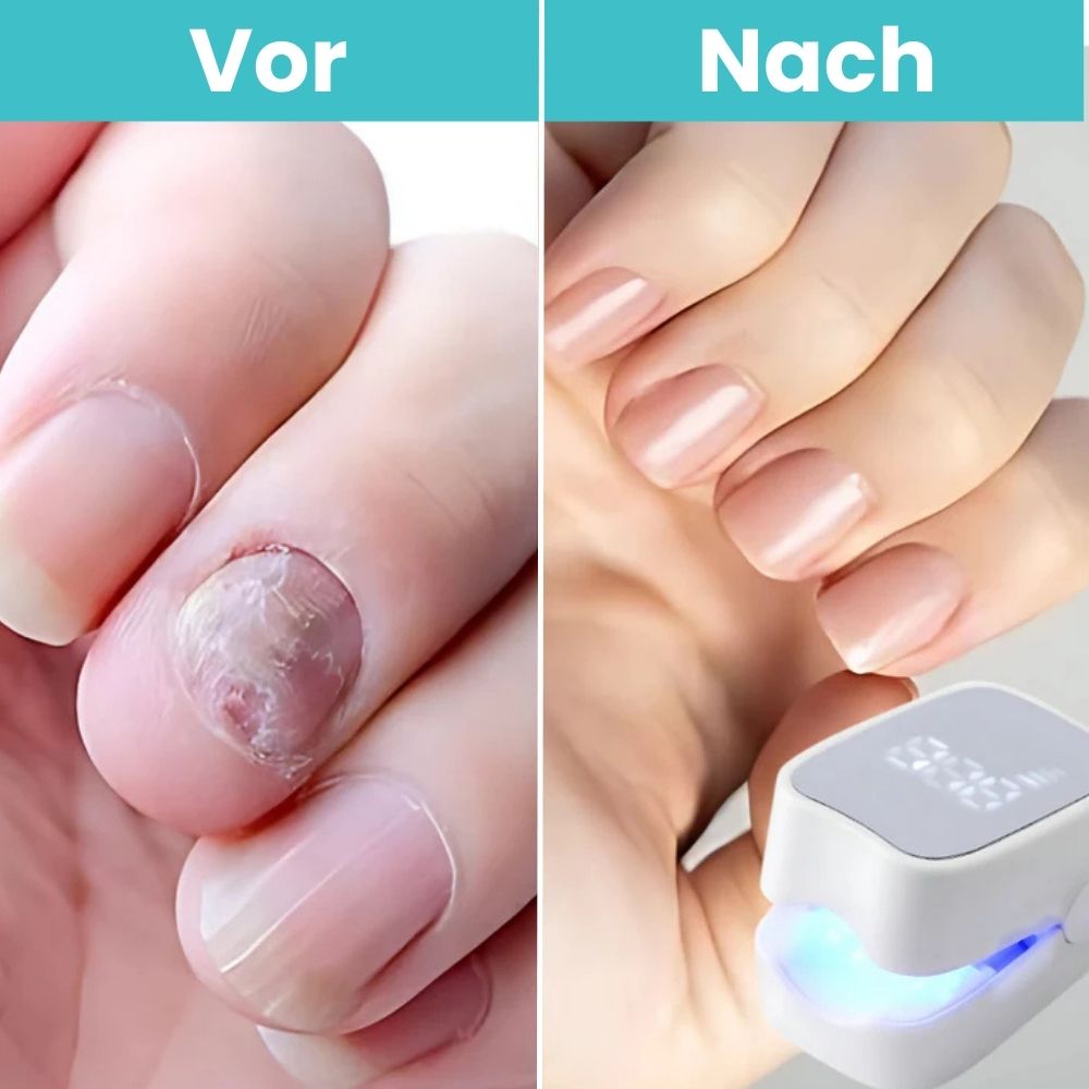 FungiClear Pro™ | Klare, Gesund Aussehende Nägel Zu Hause Wiederherstellen