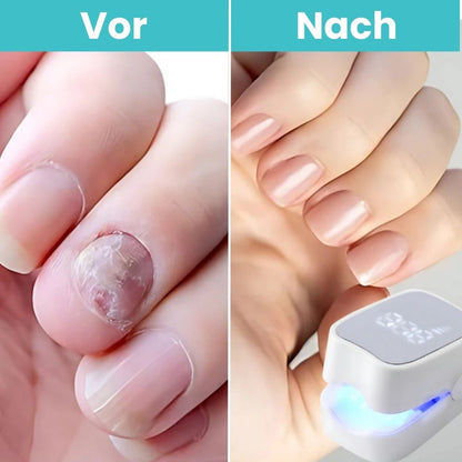 FungiClear Pro™ | Klare, Gesund Aussehende Nägel Zu Hause Wiederherstellen