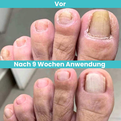 FungiClear Pro V2™ - Professionelle Heimbehandlung